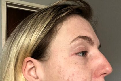 Ashlee Crumpton, from Wales, goes viral on TikTok sharing her severe Accutane side effects, including painful cysts and harsh online comments, in her fight against cystic acne.