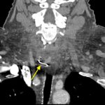 74-year-old man accidentally swallows denture, leading to severe sore throat and shortness of breath. CT scan reveals lodged denture, successfully removed via surgery.