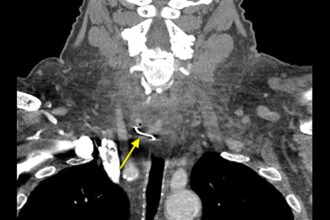 74-year-old man accidentally swallows denture, leading to severe sore throat and shortness of breath. CT scan reveals lodged denture, successfully removed via surgery.