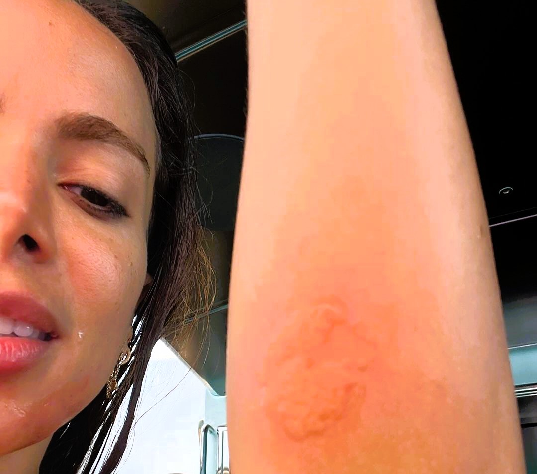 Singer Anitta, 31, shared her painful experience after being stung by a jellyfish in Ibiza, showing injuries on Instagram and describing the intense pain she felt.