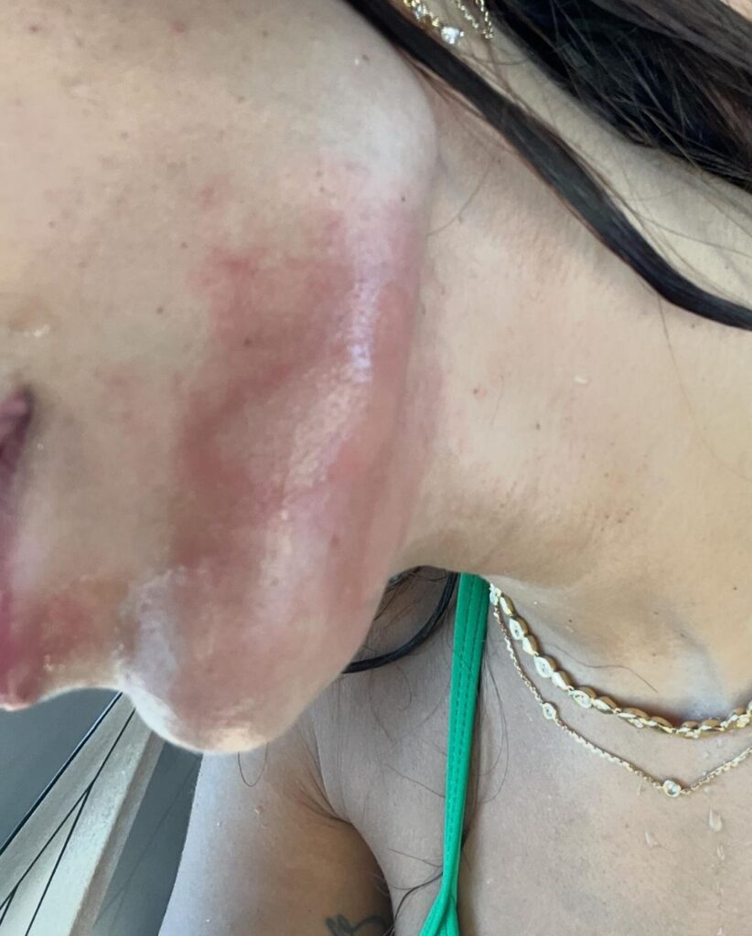 Singer Anitta, 31, shared her painful experience after being stung by a jellyfish in Ibiza, showing injuries on Instagram and describing the intense pain she felt.