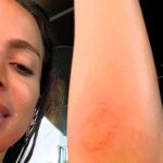 Singer Anitta, 31, shared her painful experience after being stung by a jellyfish in Ibiza, showing injuries on Instagram and describing the intense pain she felt.