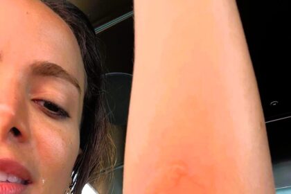 Singer Anitta, 31, shared her painful experience after being stung by a jellyfish in Ibiza, showing injuries on Instagram and describing the intense pain she felt.