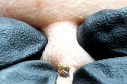 Viral blackhead removal video from Kolaine Beauty Lounge shocks viewers with 11M+ views. Watch the satisfying extraction and get expert tips to keep your skin clear.