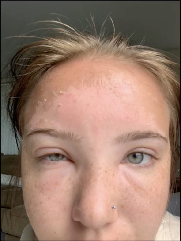 TikToker shares her severe sunburn experience, leading to a 'squishy' forehead and shocking millions with a viral video. After days of recovery, she vows to never skip sunscreen again.