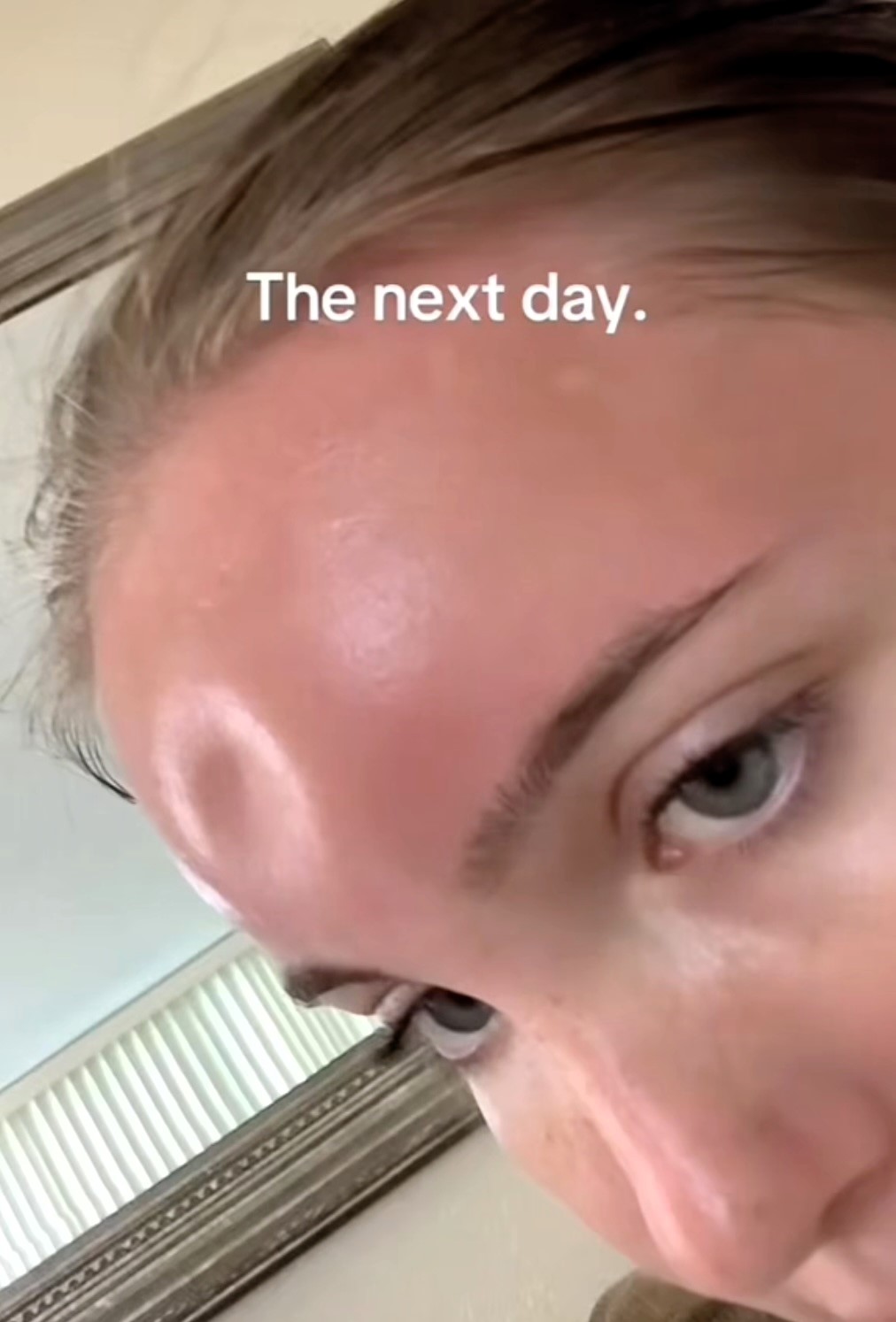 TikToker shares her severe sunburn experience, leading to a 'squishy' forehead and shocking millions with a viral video. After days of recovery, she vows to never skip sunscreen again.