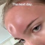 TikToker shares her severe sunburn experience, leading to a 'squishy' forehead and shocking millions with a viral video. After days of recovery, she vows to never skip sunscreen again.