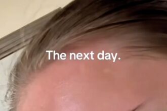 TikToker shares her severe sunburn experience, leading to a 'squishy' forehead and shocking millions with a viral video. After days of recovery, she vows to never skip sunscreen again.