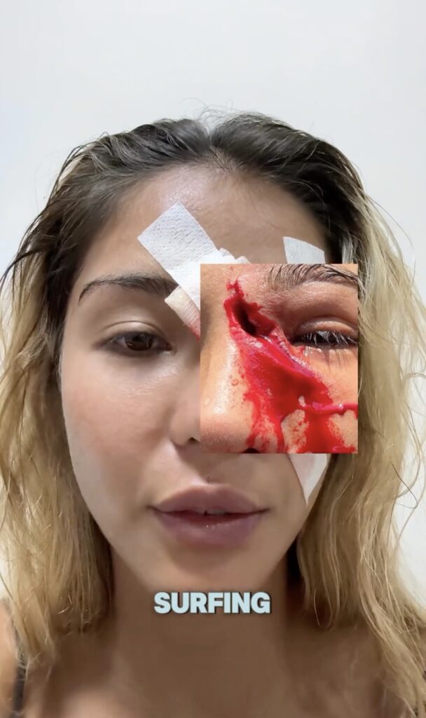 Surfer Talitha Tan narrowly escapes a severe facial injury in a horror wave collision, sharing her recovery journey with 713K+ viewers on Instagram. Her strength inspires.