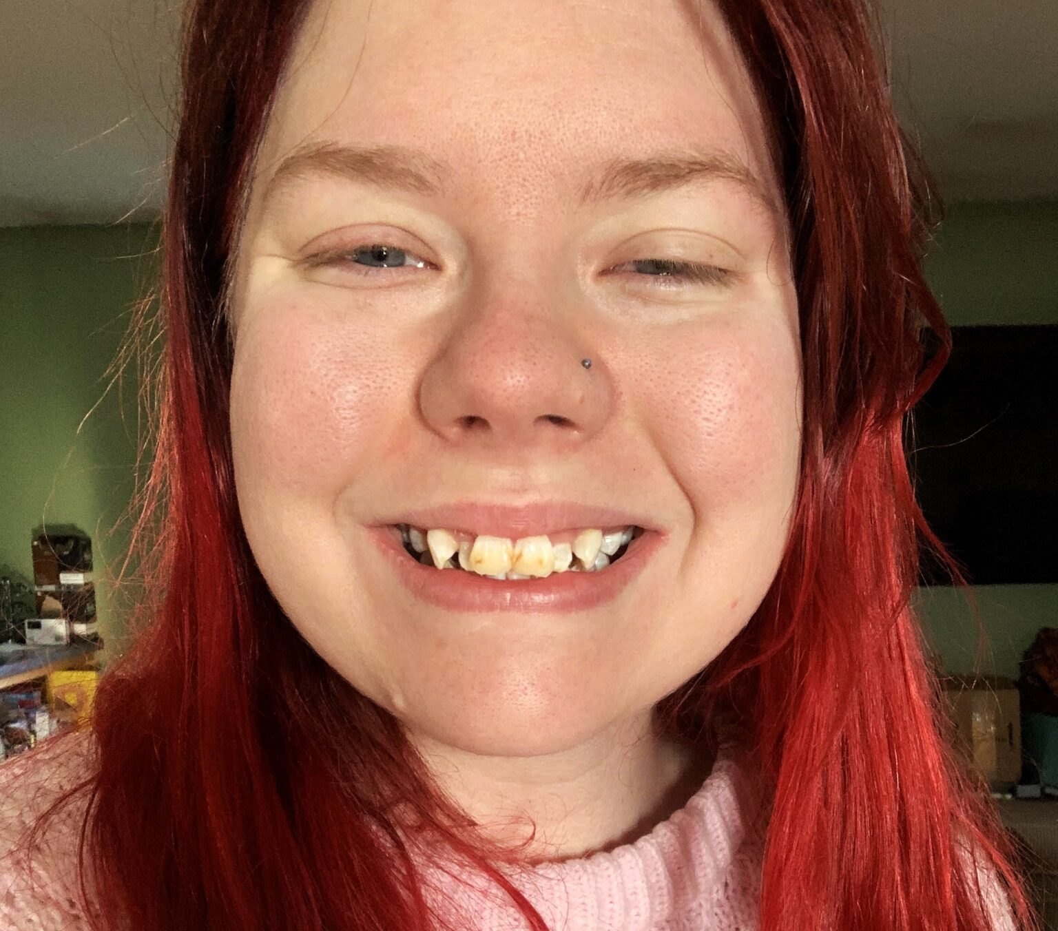 After years of bullying, Amber Murphy, 26, transforms her smile with braces, boosting her confidence. Her £5,800 journey proves it’s never too late to reclaim your self-esteem.