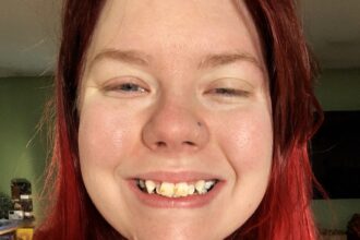 After years of bullying, Amber Murphy, 26, transforms her smile with braces, boosting her confidence. Her £5,800 journey proves it’s never too late to reclaim your self-esteem.