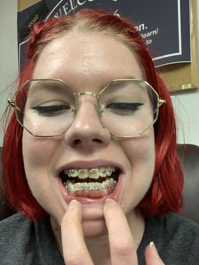 After years of bullying, Amber Murphy, 26, transforms her smile with braces, boosting her confidence. Her £5,800 journey proves it’s never too late to reclaim your self-esteem.