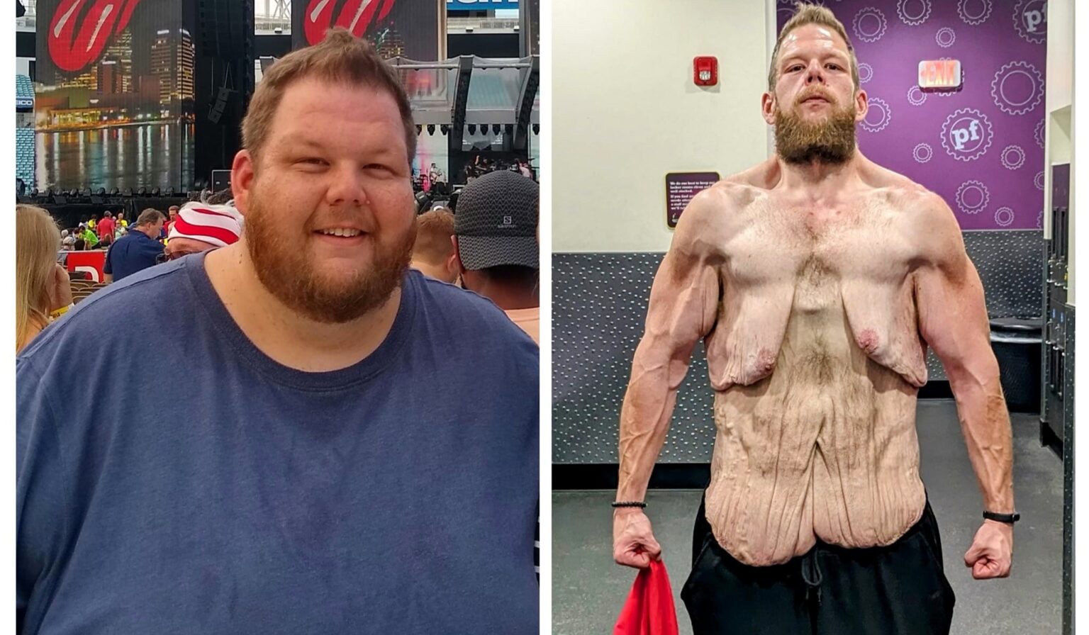 After losing 25 stone, Cole Prochaska faces £230k surgery to remove excess skin. His inspiring weight loss journey proves that life-changing transformations are possible.