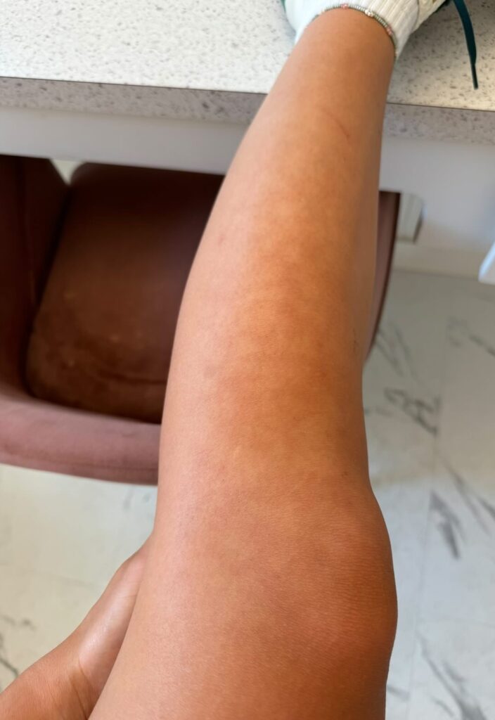 A woman develops ‘toasted skin’ syndrome after sitting too close to a heater, sharing her story online to warn others about the dangers of prolonged heat exposure to the skin.