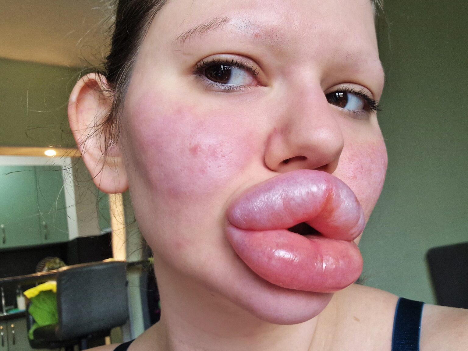 Andrea Ivanova, known for her extreme look, ditches lip filler for an umbilical cord cell procedure, claiming it makes her look 10 years younger.