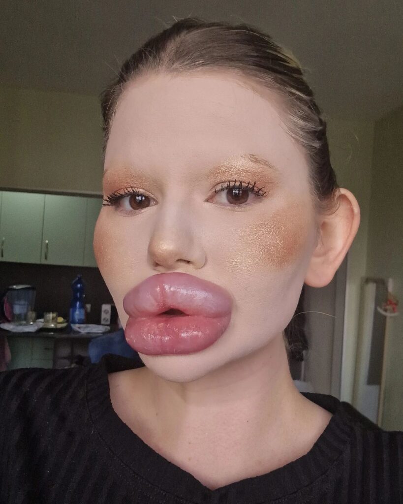 Andrea Ivanova, known for her extreme look, ditches lip filler for an umbilical cord cell procedure, claiming it makes her look 10 years younger.