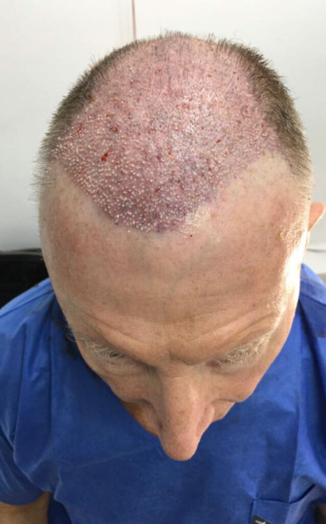 After a transformative hair transplant, 77-year-old Alan Gooding claims people see him as '15 years younger,' boosting his confidence and zest for life.