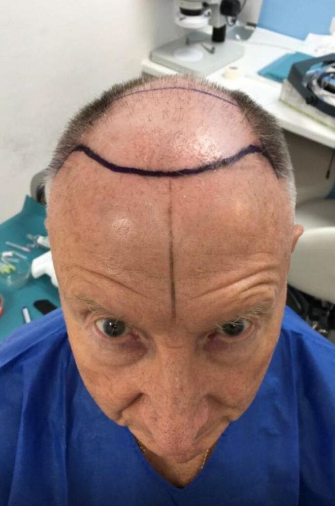 After a transformative hair transplant, 77-year-old Alan Gooding claims people see him as '15 years younger,' boosting his confidence and zest for life.