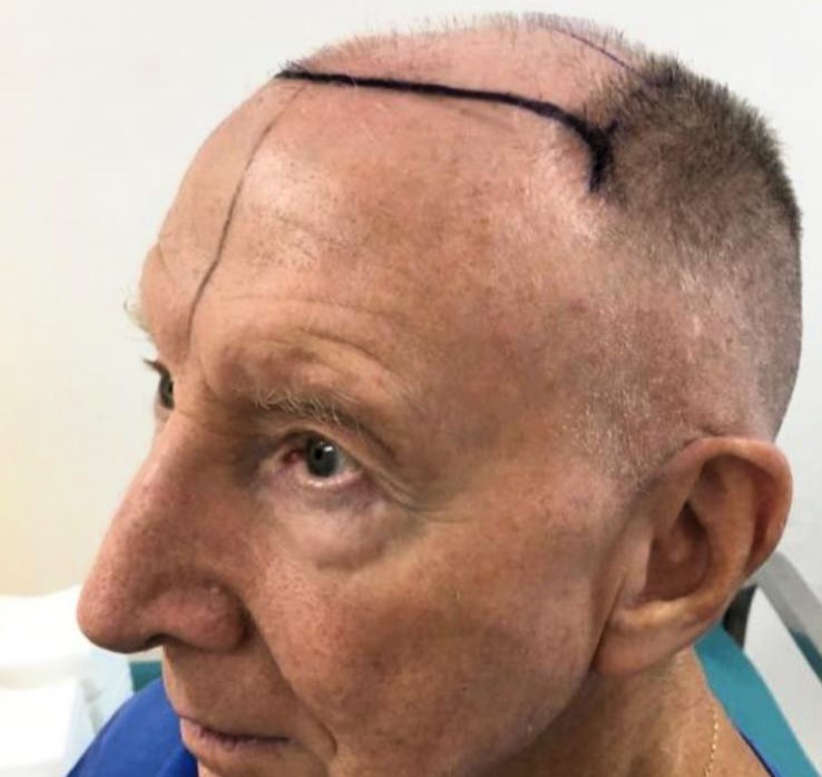 After a transformative hair transplant, 77-year-old Alan Gooding claims people see him as '15 years younger,' boosting his confidence and zest for life.