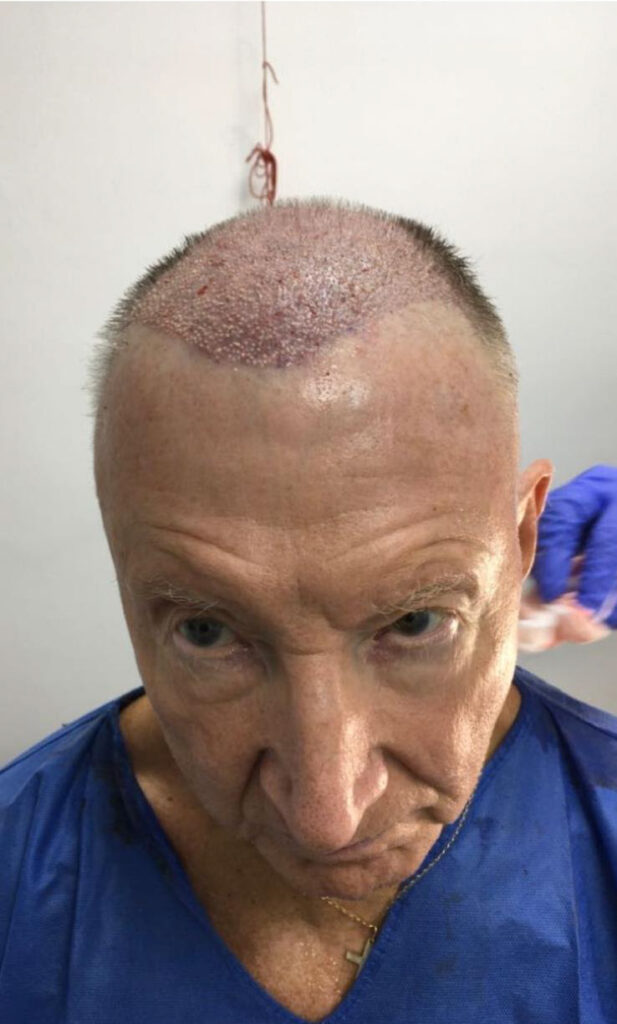 After a transformative hair transplant, 77-year-old Alan Gooding claims people see him as '15 years younger,' boosting his confidence and zest for life.