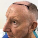 After a transformative hair transplant, 77-year-old Alan Gooding claims people see him as '15 years younger,' boosting his confidence and zest for life.