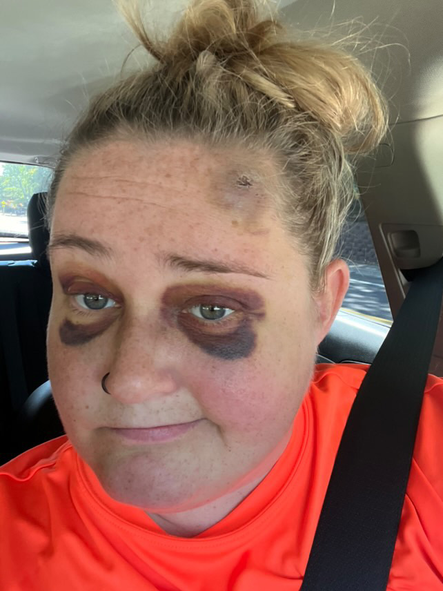 A bride went viral after sharing her incredible transformation following a severe softball injury just five days before her wedding. Thanks to expert makeup, she stunned on her big day!