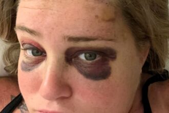 A bride went viral after sharing her incredible transformation following a severe softball injury just five days before her wedding. Thanks to expert makeup, she stunned on her big day!