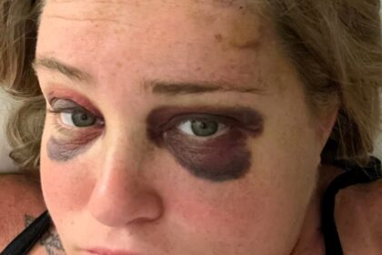 A bride went viral after sharing her incredible transformation following a severe softball injury just five days before her wedding. Thanks to expert makeup, she stunned on her big day!