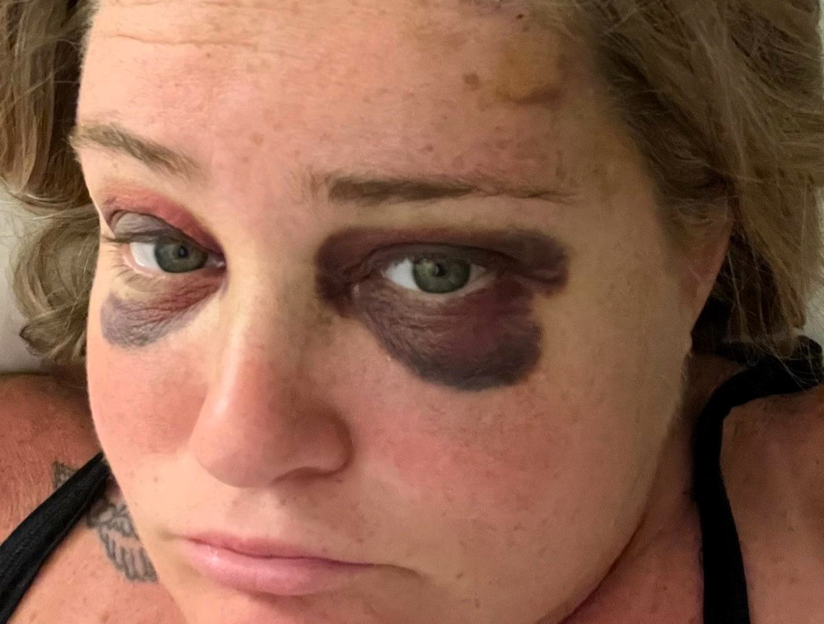 A bride went viral after sharing her incredible transformation following a severe softball injury just five days before her wedding. Thanks to expert makeup, she stunned on her big day!