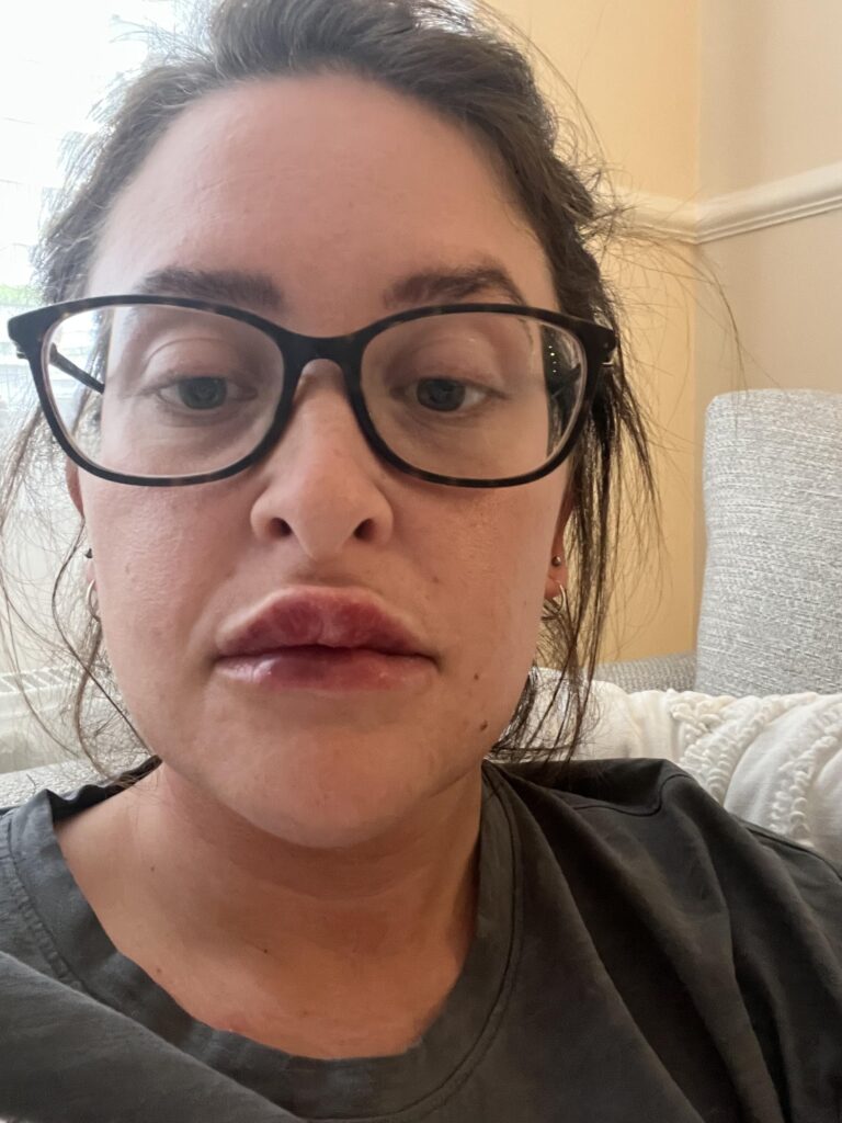 British woman shares botched lip filler ordeal, with extreme swelling and bruising, urging others to research practitioners and prioritize safety over cost.