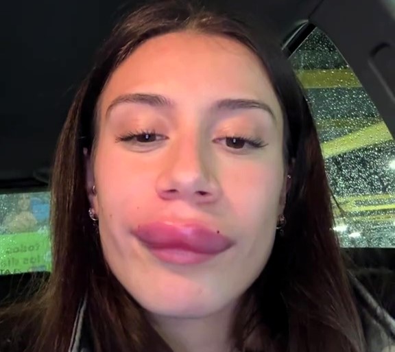 Personal trainer's lip filler removal goes hilariously wrong, leaving her with a comically swollen face. She shares her experience to warn others about the risks of cosmetic procedures.