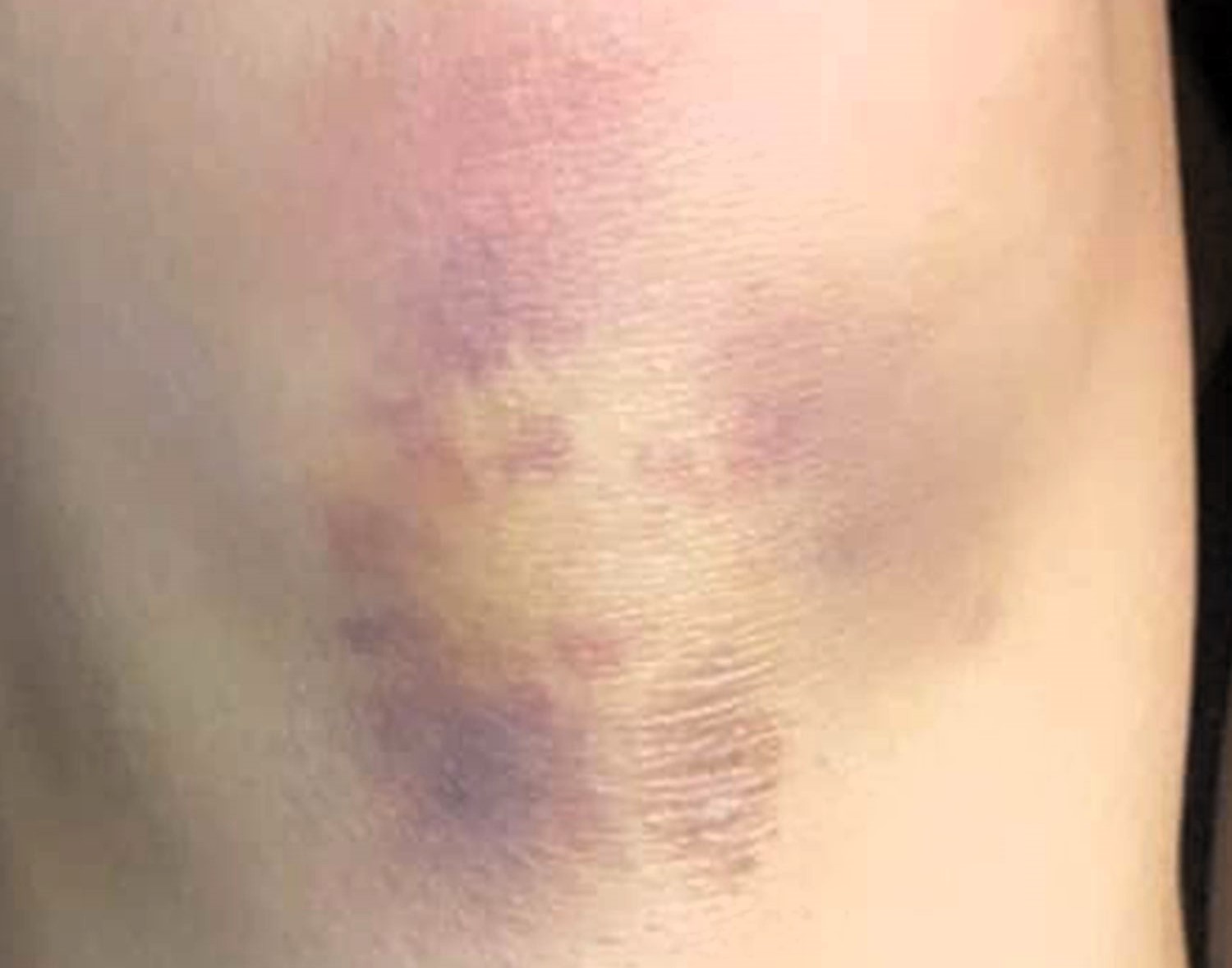 A woman in Mexico claims a bruise on her knee resembles Cher, sparking viral reactions from friends who spot the singer’s iconic features in the black-and-blue mark.