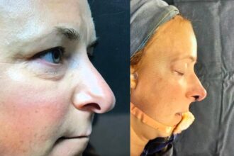 A woman has gone viral after revealing the raw truth of her £5,400 nose job - from painful recovery to newfound confidence in her side profile.