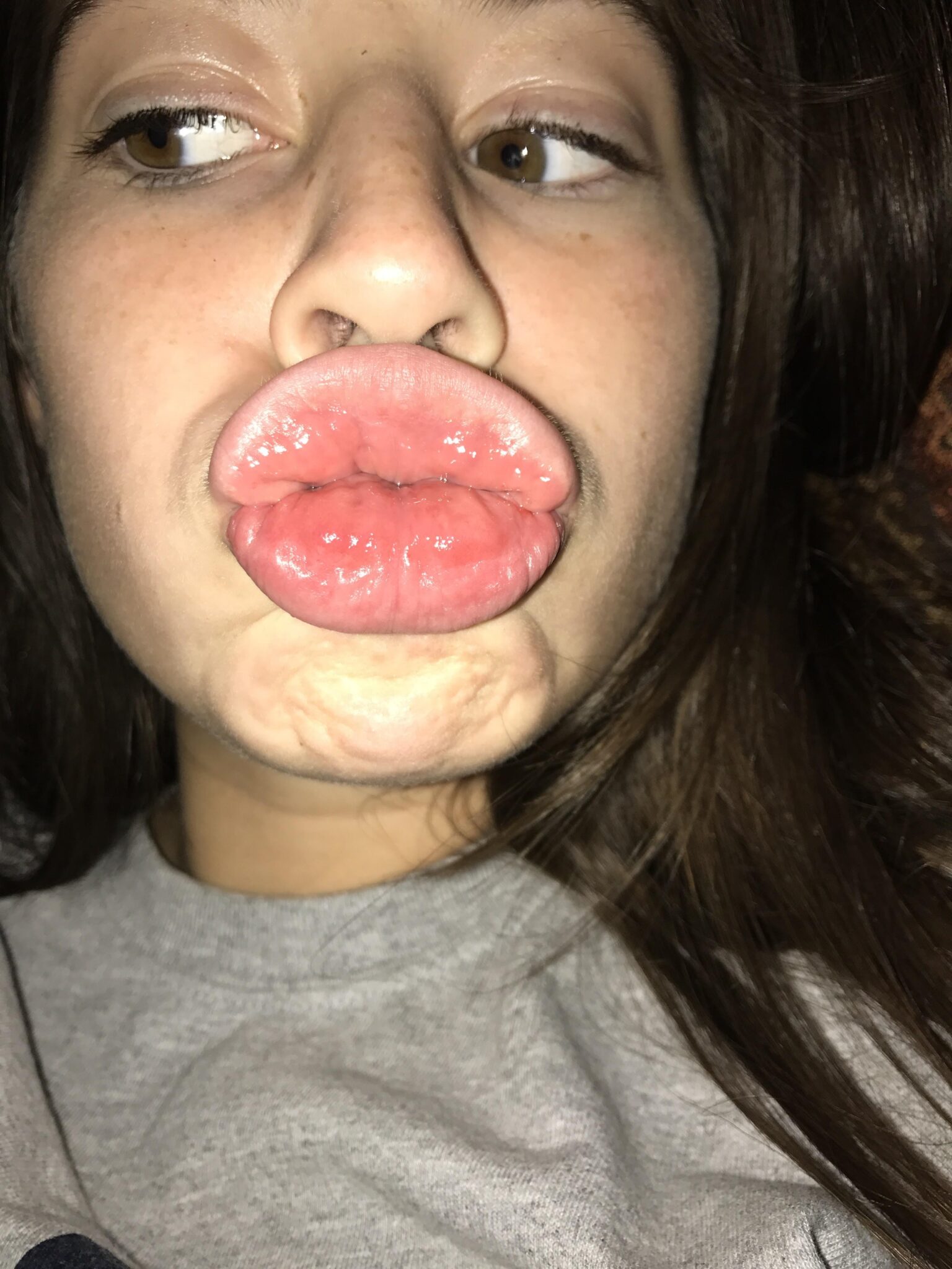 ‘I get trolled every day because of my HUGE lips people compare me to