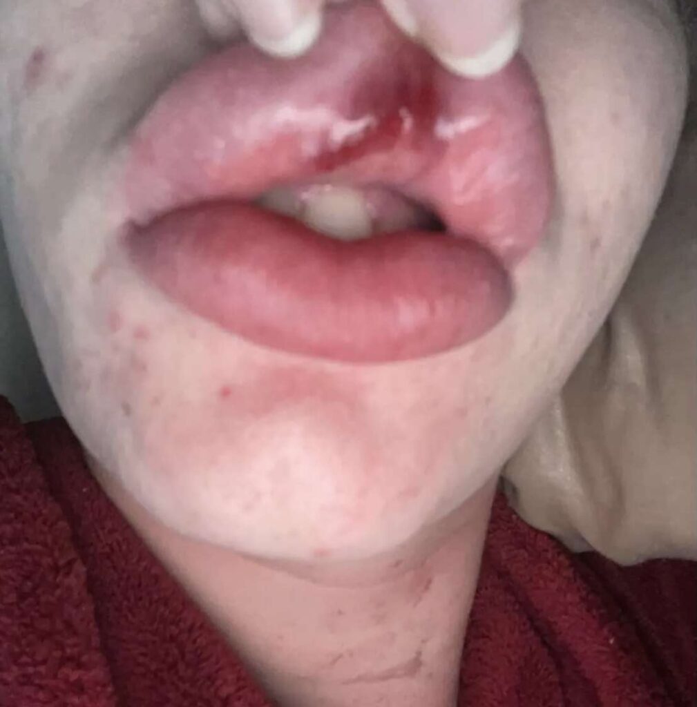 Jolene Dawson spent £6,000 transforming herself to look like a cat in a publicity stunt but now regrets the painful side effects and is seeking to reverse the procedures.
