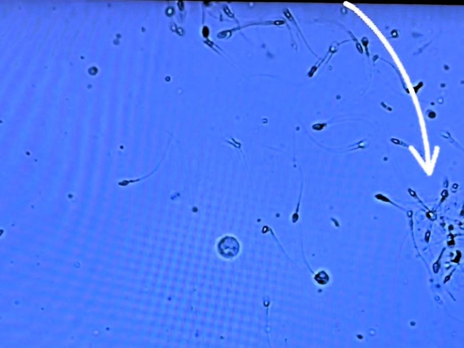 Fertility doctor goes viral after revealing how to spot 'bad' sperm under microscope - only 4 percent need to be normal for a sample to be viable.