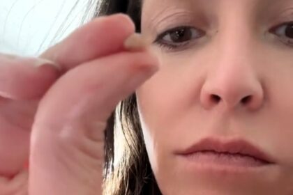 Anne Marie, fed up with costly healthcare, went viral after cutting off her own mole with manicure scissors, sparking debate over DIY dermatology and US medical costs.