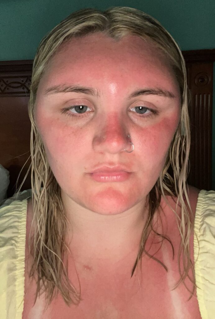 A woman’s face swelled so badly from sun poisoning in the Dominican Republic her own mum did not recognize her - even with sunscreen and aloe vera gel.