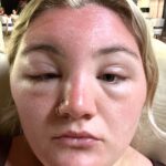 A woman’s face swelled so badly from sun poisoning in the Dominican Republic her own mum did not recognize her - even with sunscreen and aloe vera gel.