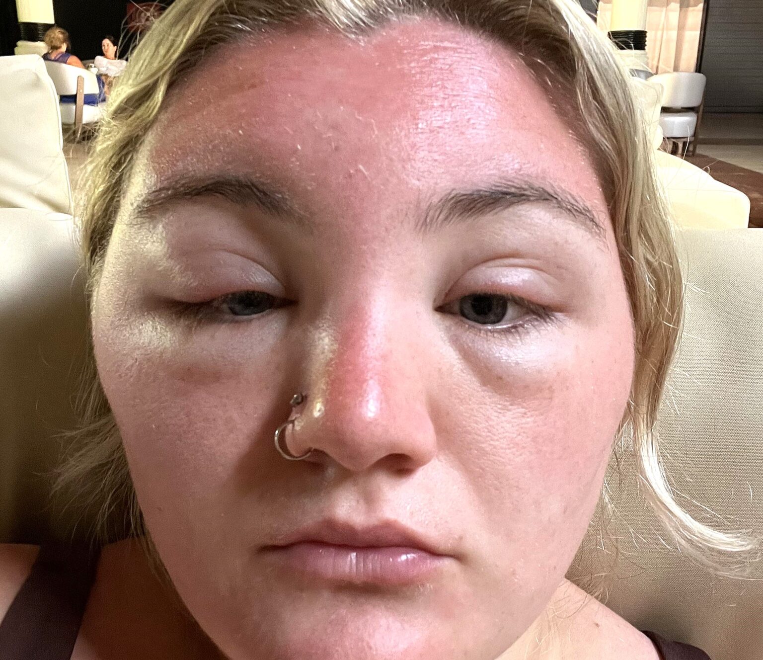 A woman’s face swelled so badly from sun poisoning in the Dominican Republic her own mum did not recognize her - even with sunscreen and aloe vera gel.