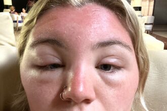 A woman’s face swelled so badly from sun poisoning in the Dominican Republic her own mum did not recognize her - even with sunscreen and aloe vera gel.