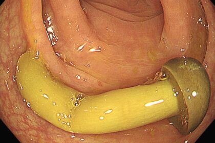 Doctor finds whole enoki mushroom in patient's colon during scan - warns to chew properly as tough chitin cell walls make it pass undigested, earning nickname 'see you tomorrow'.