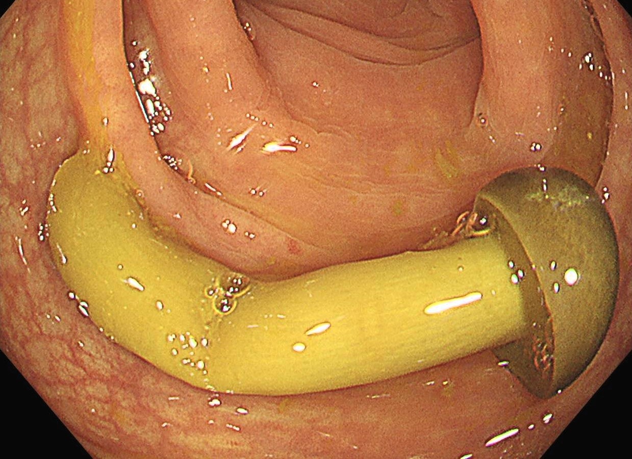 Doctor finds whole enoki mushroom in patient's colon during scan - warns to chew properly as tough chitin cell walls make it pass undigested, earning nickname 'see you tomorrow'.