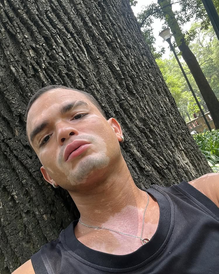 Model and actor Daniel Ruenes says his vitiligo has stalled his TV career, forcing him to work in a supermarket as he waits for new roles and a shot to revive his dream.