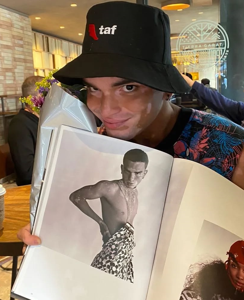 Model and actor Daniel Ruenes says his vitiligo has stalled his TV career, forcing him to work in a supermarket as he waits for new roles and a shot to revive his dream.