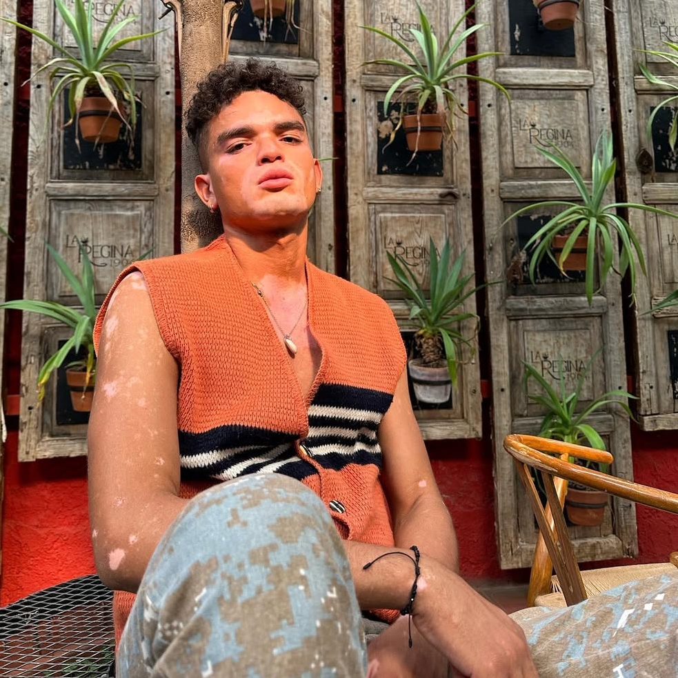 Model and actor Daniel Ruenes says his vitiligo has stalled his TV career, forcing him to work in a supermarket as he waits for new roles and a shot to revive his dream.