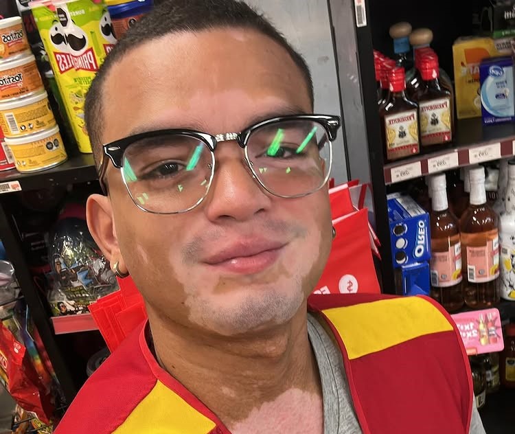 Model and actor Daniel Ruenes says his vitiligo has stalled his TV career, forcing him to work in a supermarket as he waits for new roles and a shot to revive his dream.