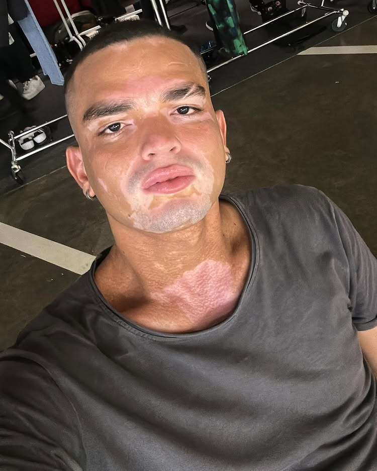 Model and actor Daniel Ruenes says his vitiligo has stalled his TV career, forcing him to work in a supermarket as he waits for new roles and a shot to revive his dream.