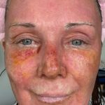 A mum claims a £4,250 CO2 laser treatment took 20 years off her face without surgery. Her viral TikTok posts show the stunning transformation and boost in confidence.
