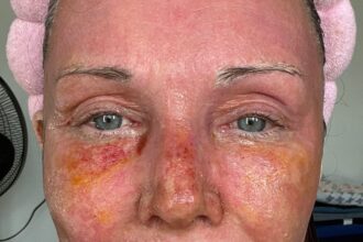 A mum claims a £4,250 CO2 laser treatment took 20 years off her face without surgery. Her viral TikTok posts show the stunning transformation and boost in confidence.